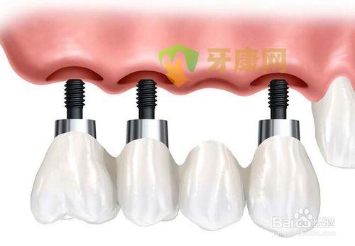 做種植牙修復(fù)牙齒缺失的結(jié)果怎么樣
