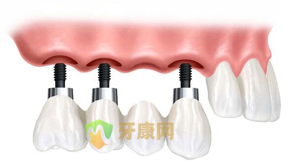 種植牙手術疼不疼