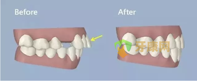 成年人牙齒前突怎么矯正