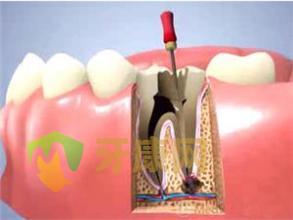根管治療能夠治療牙痛嗎