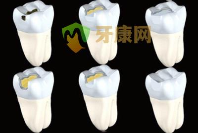 補(bǔ)牙的誤區(qū)