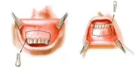 骨性齙牙和非骨性齙牙的區別