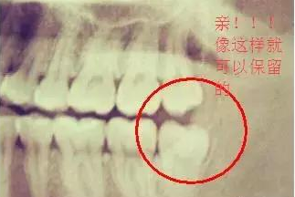 位置正可以保留的智齒