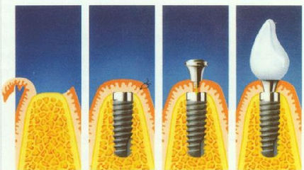 種植牙可以不磨好牙