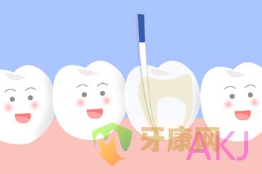 根管治療 根管治療