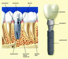 種植牙有沒(méi)有年齡