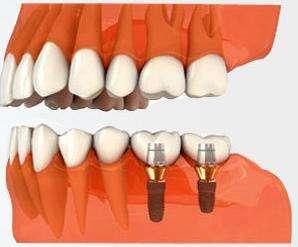 后牙種植牙價格