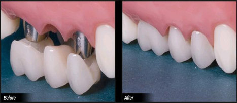 深圳種植牙易感染期較容易出現的問題 