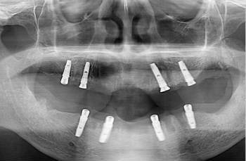 深圳種植牙較便宜的多少錢